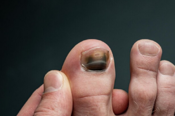 What causes nail fungus