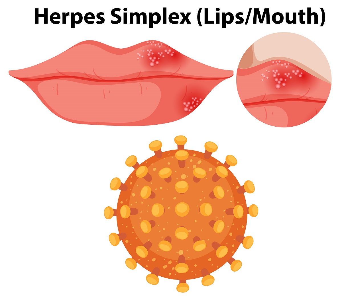 What Does Herpes Look Like? Oral and Genital Herps Symptoms