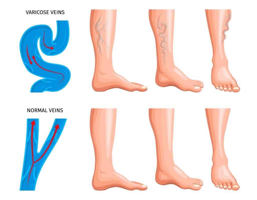 What is a varicose vein