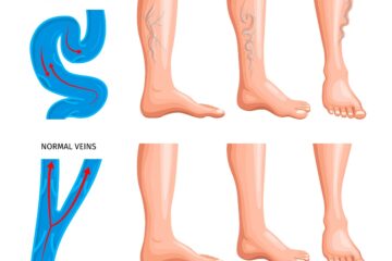 What is a varicose vein